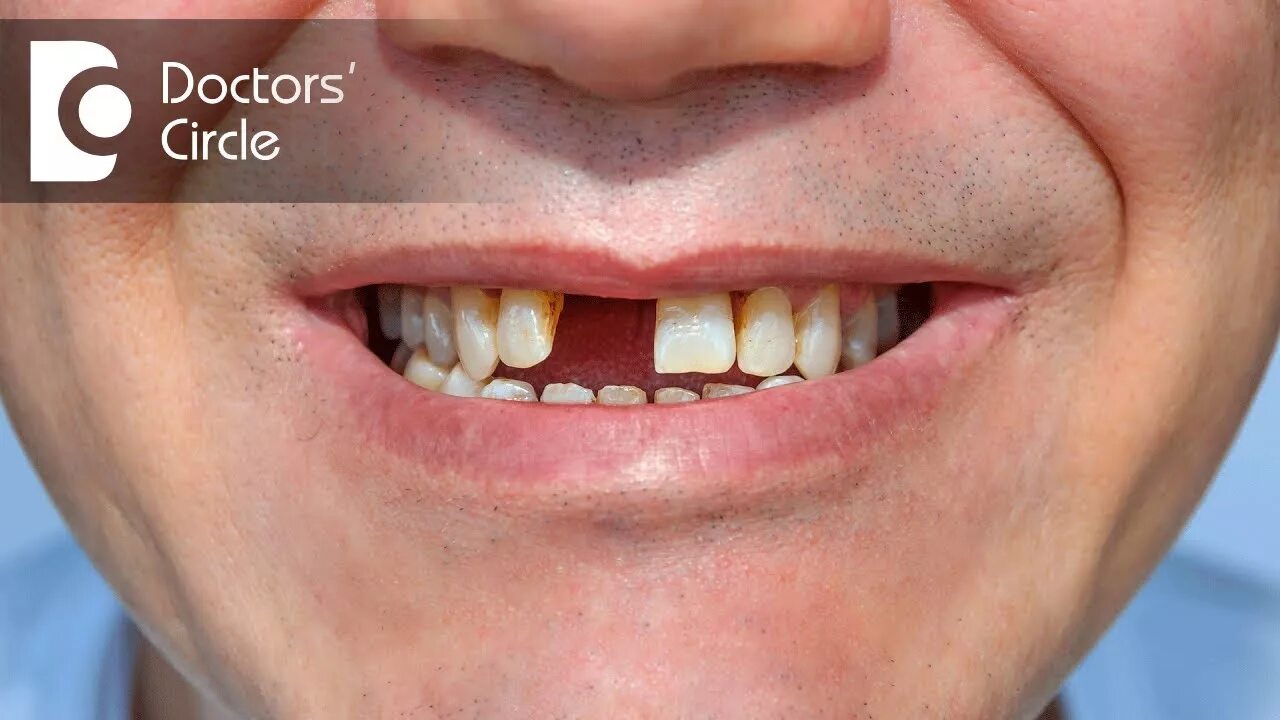 Плохие зубы фото Is a Dental Bridge removable? - Dr. Mohammed Fayaz Pasha - YouTube