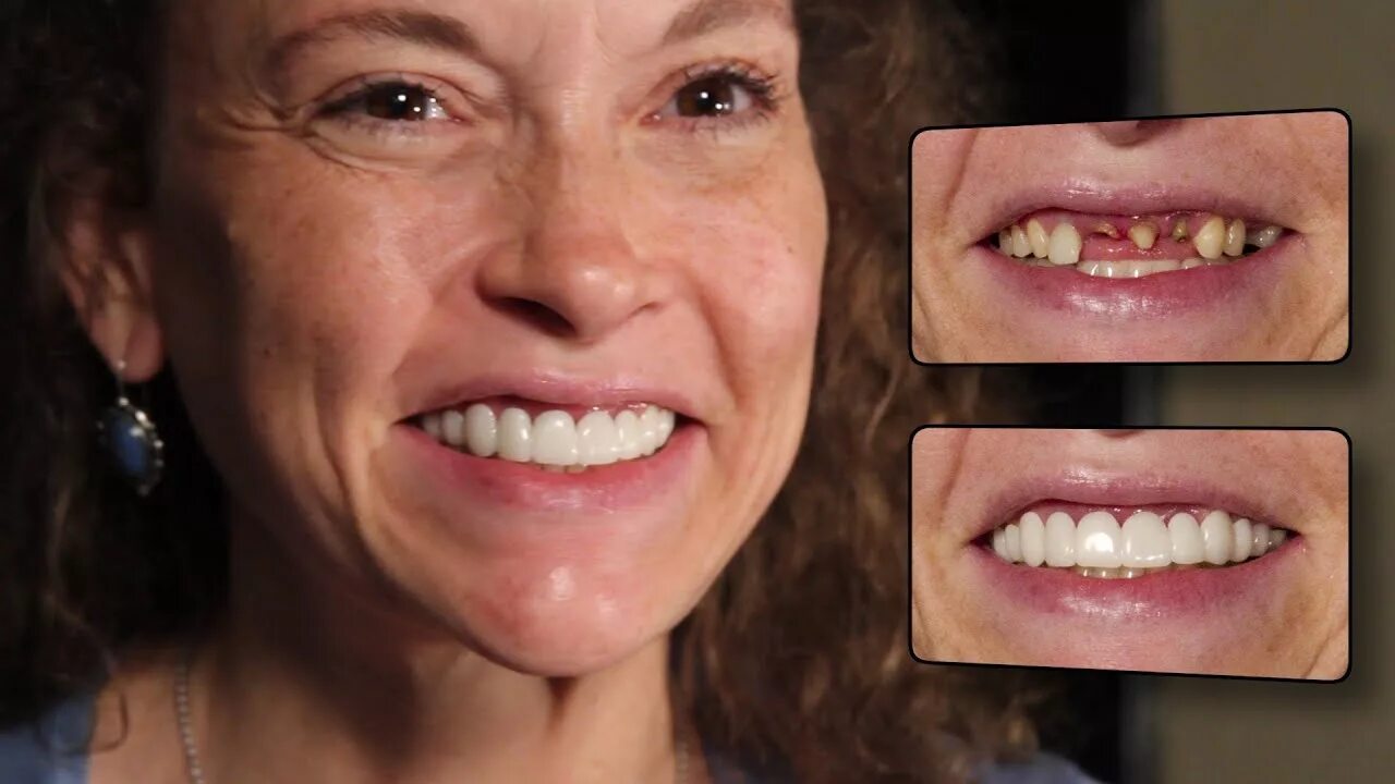 Плохие зубы фото у девушек New Press On Veneers by Brighter Image Lab are Changing Lives - YouTube