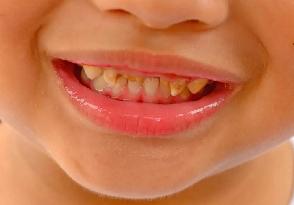 Плохие зубы у детей фото Лечение кариеса у детей в Смоленске в стоматологии Family Smile, цены и процедур