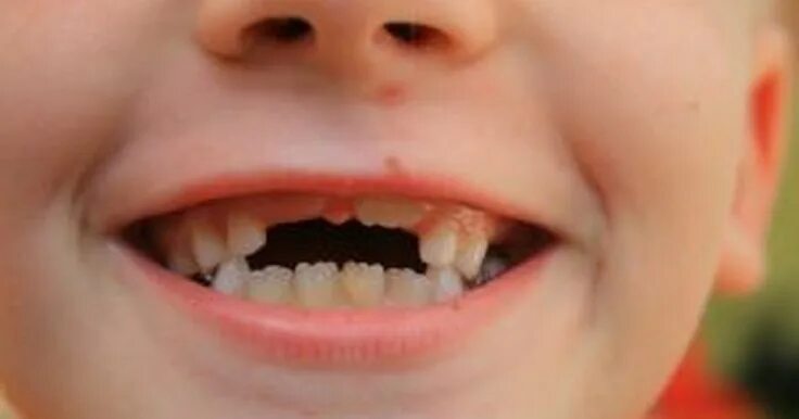 Плохие зубы у детей фото Quanto tempo leva para os filhotes de cachorro terem seus primeiros dentes Tooth