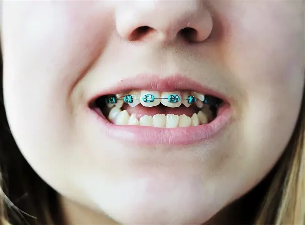 Плохие зубы у детей фото Crooked And Straight Teeth Изображения: просматривайте стоковые фотографии, вект