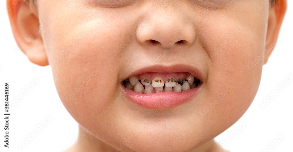 Плохие зубы у детей фото Tooth decay of children who like to eat sweets candy. And doesn't like brushing 