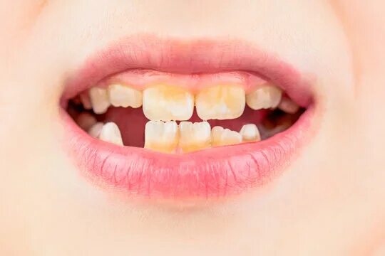 Плохие зубы у детей фото Bad Teeth Smile Изображения: просматривайте стоковые фотографии, векторные изобр