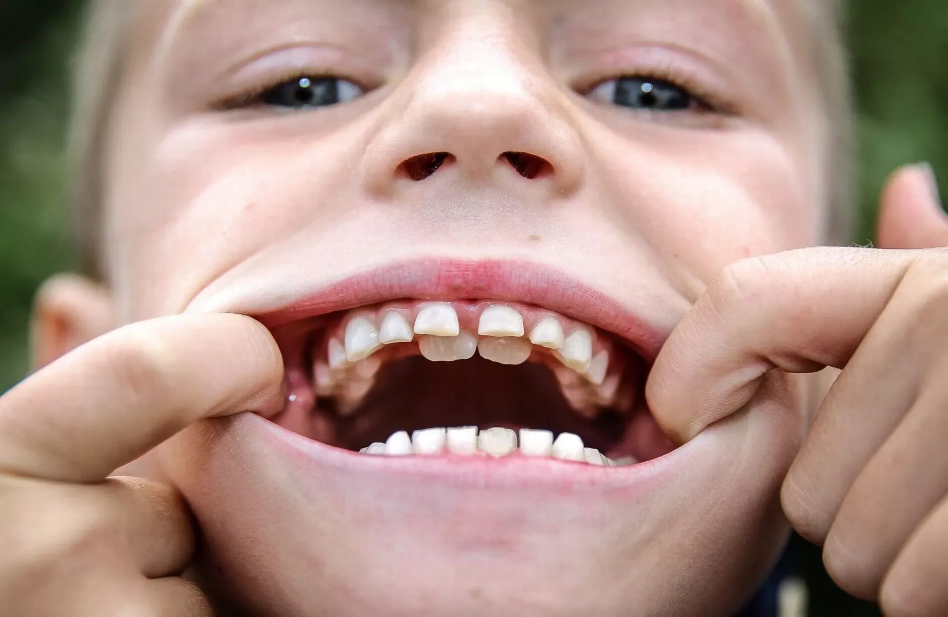 Плохие зубы у детей фото Schoolboy grows two sets of teeth - Mirror Online