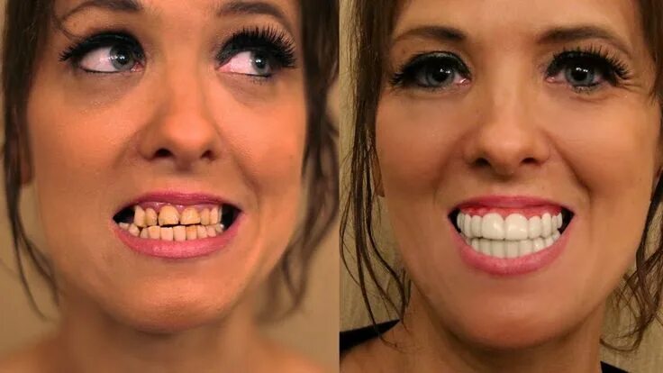 Плохое фото сделать хорошим Pin on Permanent dentures
