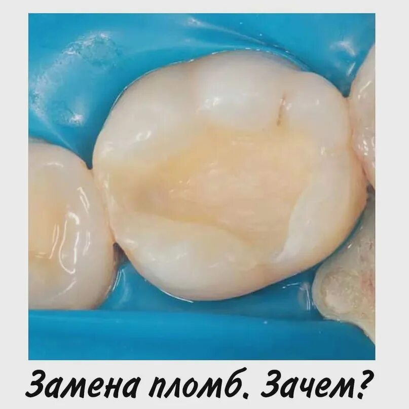Пломба фото до и после Световая или обычная пломба: какая лучше для вашей улыбки?