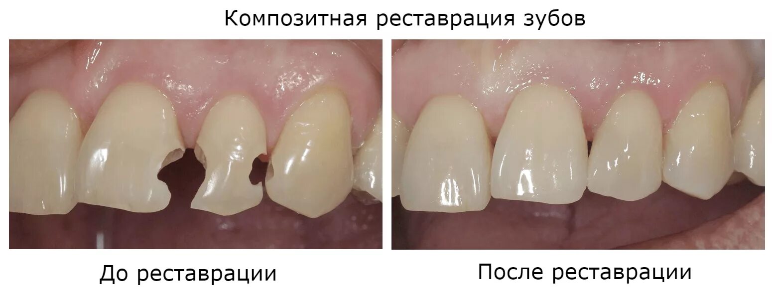 Пломба фото до и после Реставрация зубов композитным материалом