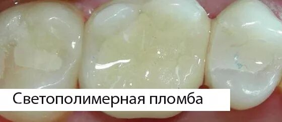 Пломба фото до и после Картинки СКОЛЬКО НЕЛЬЗЯ КУШАТЬ ПОСЛЕ УСТАНОВКИ ПЛОМБЫ