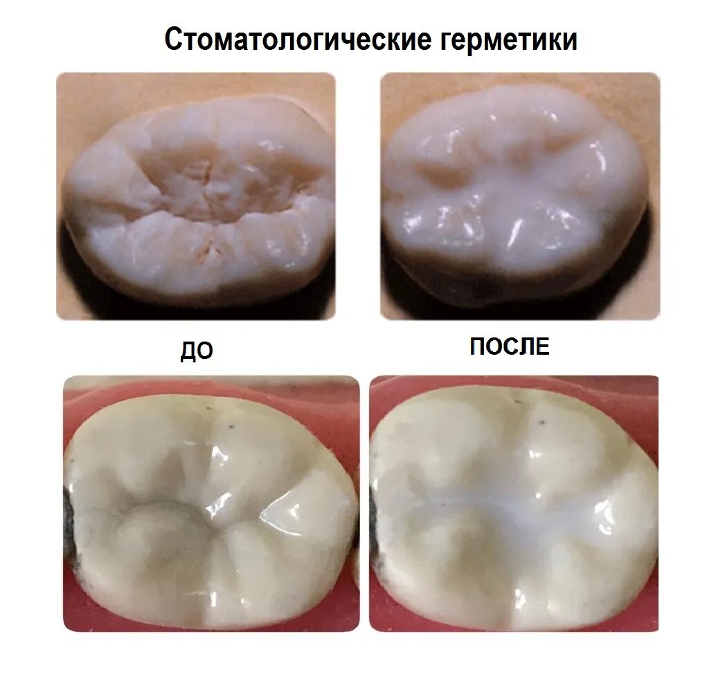 Пломба фото до и после Силанты и герметики в современной стоматологии