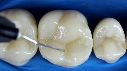 Пломба на передний зуб как выглядит Central Dentestry, dental clinic, Krasnodar, Tsentralniy City administrative dis