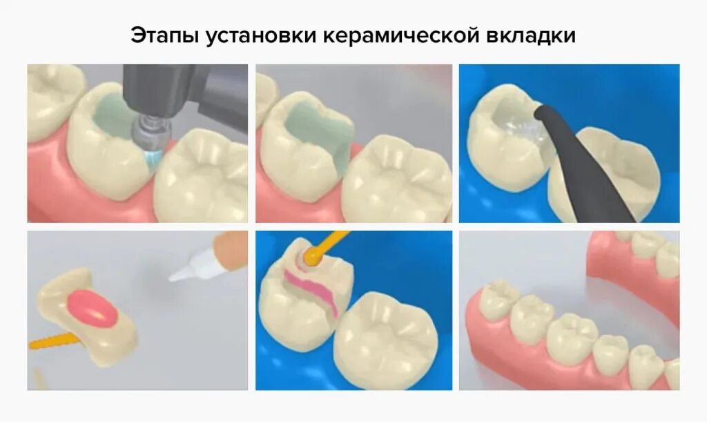 Пломба на зубе фото Пломбы и вкладки