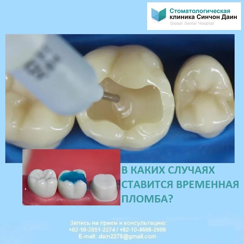 Пломба на зубе фото Платная пломба сколько гарантия