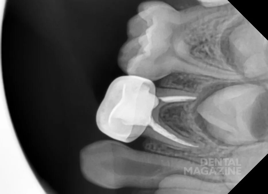 Пломбирование зуба фото Коронки для временных зубов у детей - DENTALMAGAZINE.RU