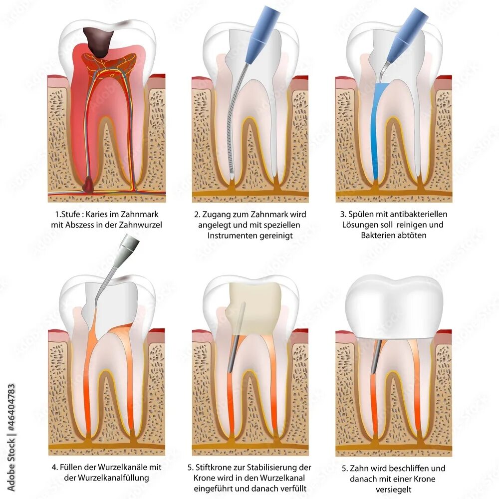 Пломбирование зуба фото Wurzelbehandlung - root canal treatment with crown Векторне зображення Stock Ado