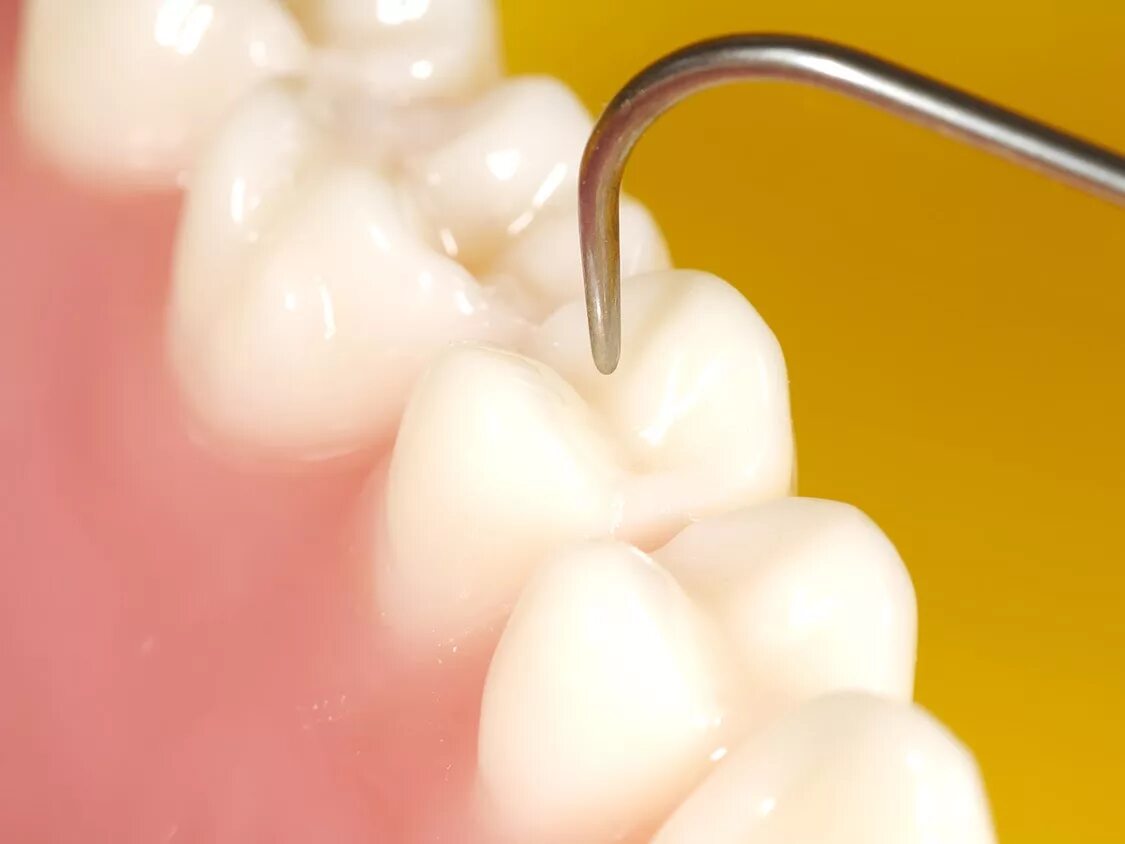 Пломбирование зуба фото Терапевтическая стоматология - интернет журнал DENTALMAGAZINE.RU