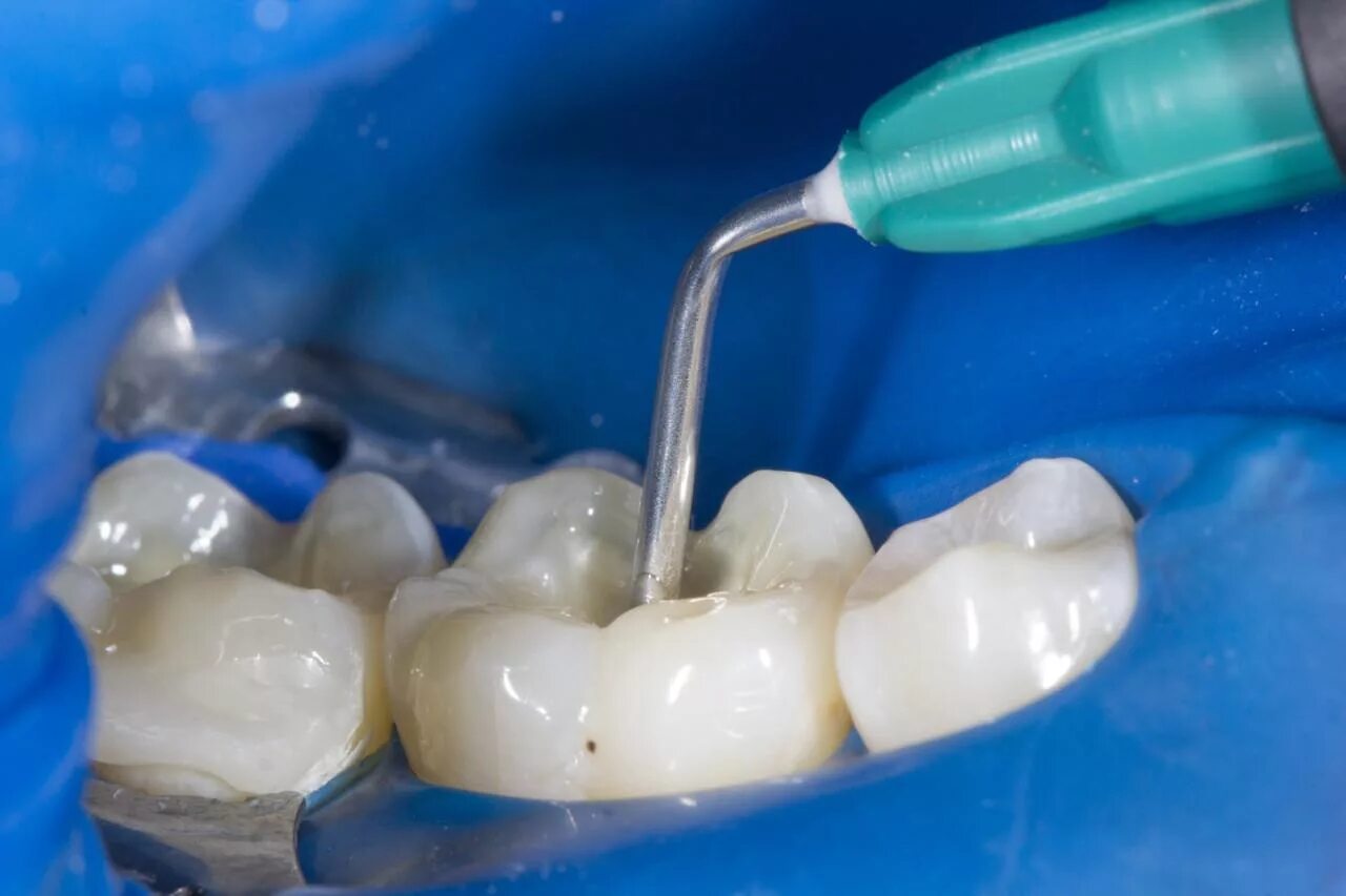 Пломбированные зубы фото Пломбирование зубов - стоматология SmileLike