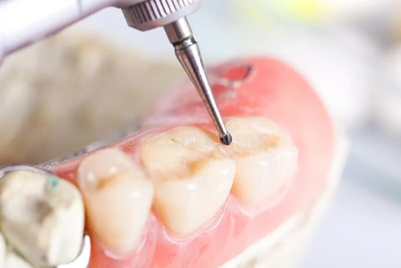 Пломбированные зубы фото Tooth Model with Metal Wire Dental Braces and Mirror Dental Equipment Stock Imag