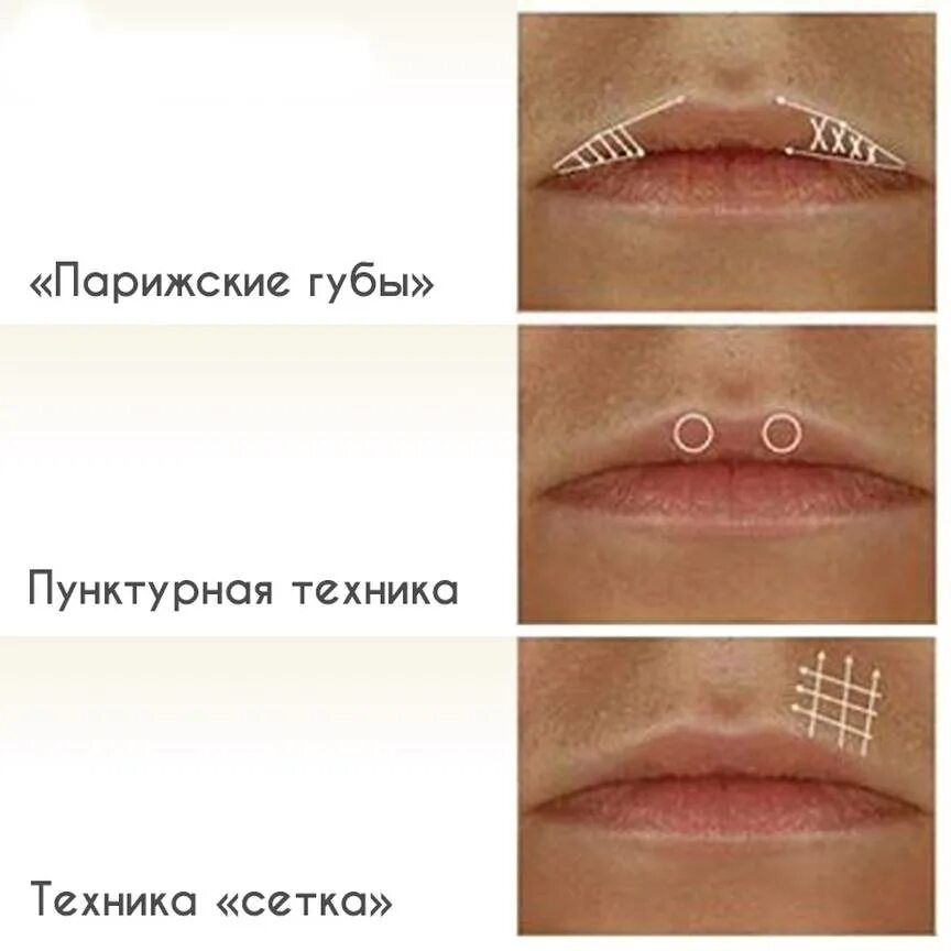 Плоская техника увеличения губ фото Филлеры в губы: отзывы, фото, техника введения