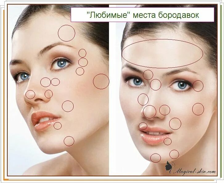Плоские бородавки на лице фото Бородавки на лице: причины, классификация, лечение, профилактика