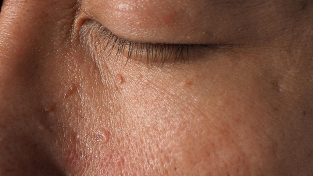 Плоские бородавки на лице фото Premium Photo Wart skin removal Macro shot of warts near eye on face Papilloma o