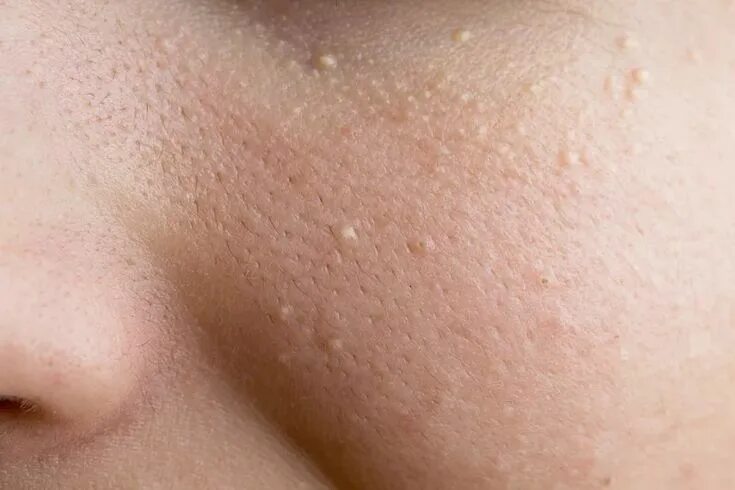 Плоские бородавки на лице фото How to Get Rid of Milia: Causes, Prevention, and Removal Skin bumps on face, Ski