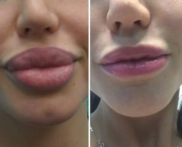 Плоские губы фото до и после #отвечаемотдохнём_военные_жизнь Who made the lips, tell your feelings during the
