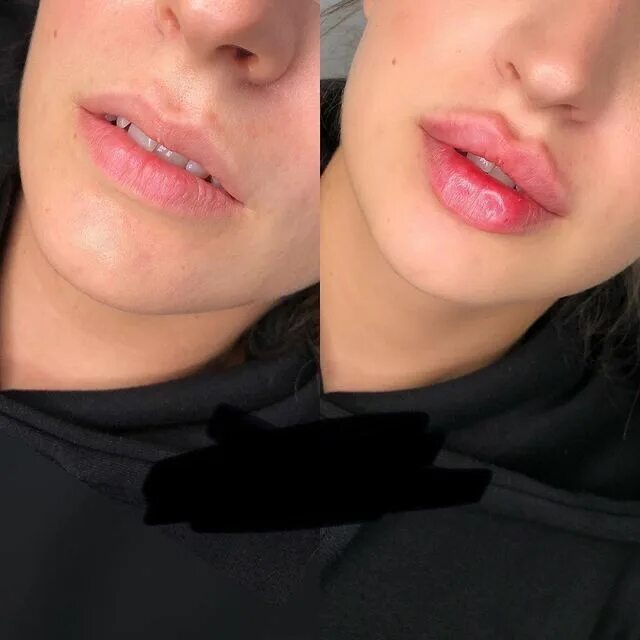 Плоские губы фото до и после Pin on Permanent makeup Lip fillers, Lip shapes, Botox lips