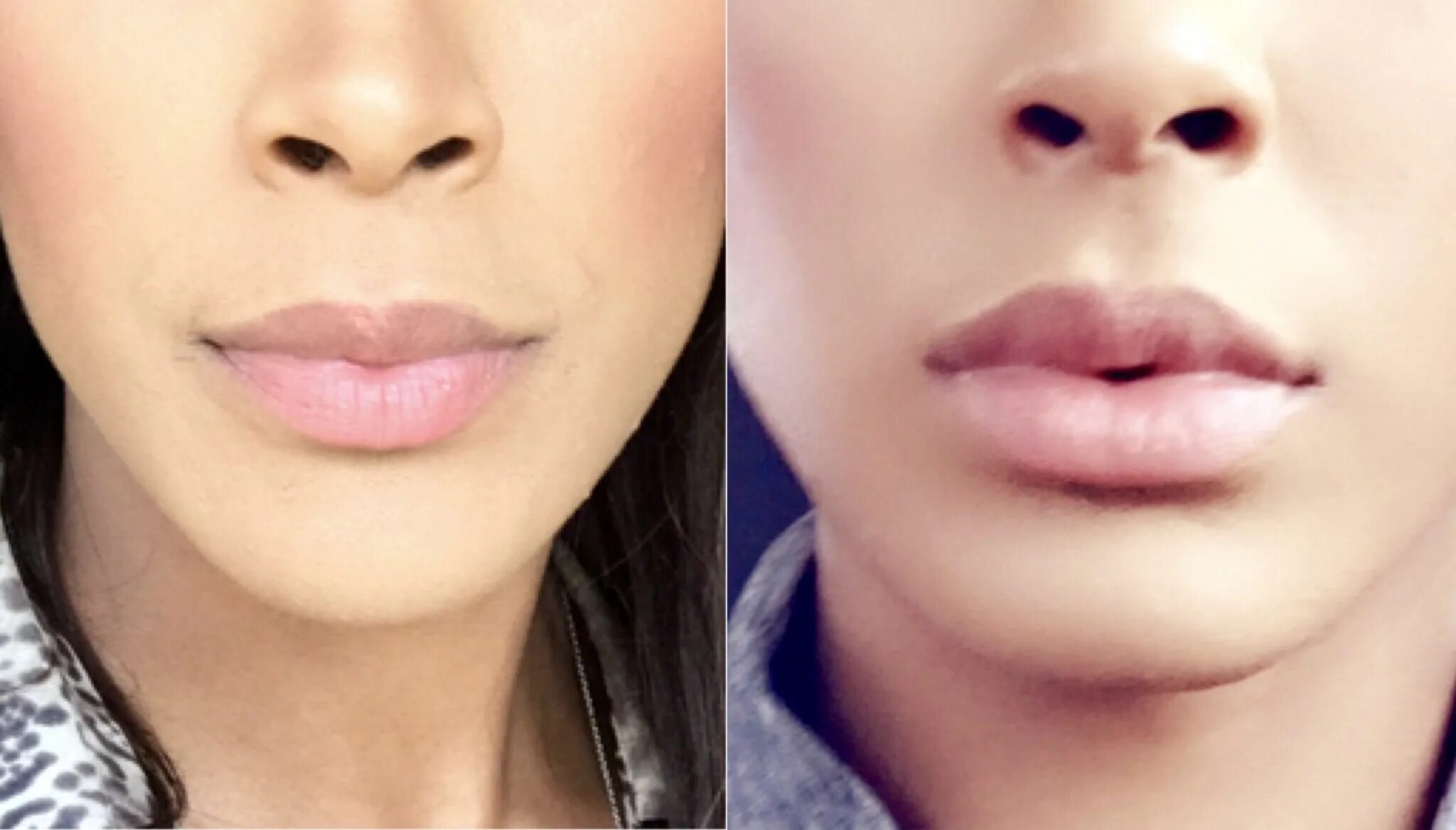 Плоские губы фото до и после 1 syringe of lip fillers #juvederm# lipfillers# beauty# kardashian# kyliejenner 