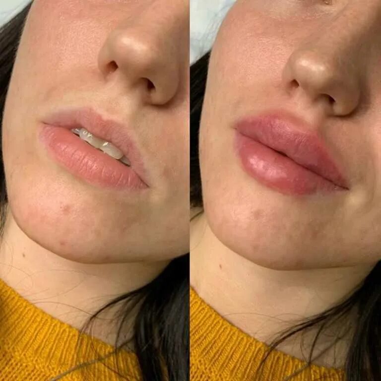 Плоские губы фото до и после Baby swollen lips after feeding