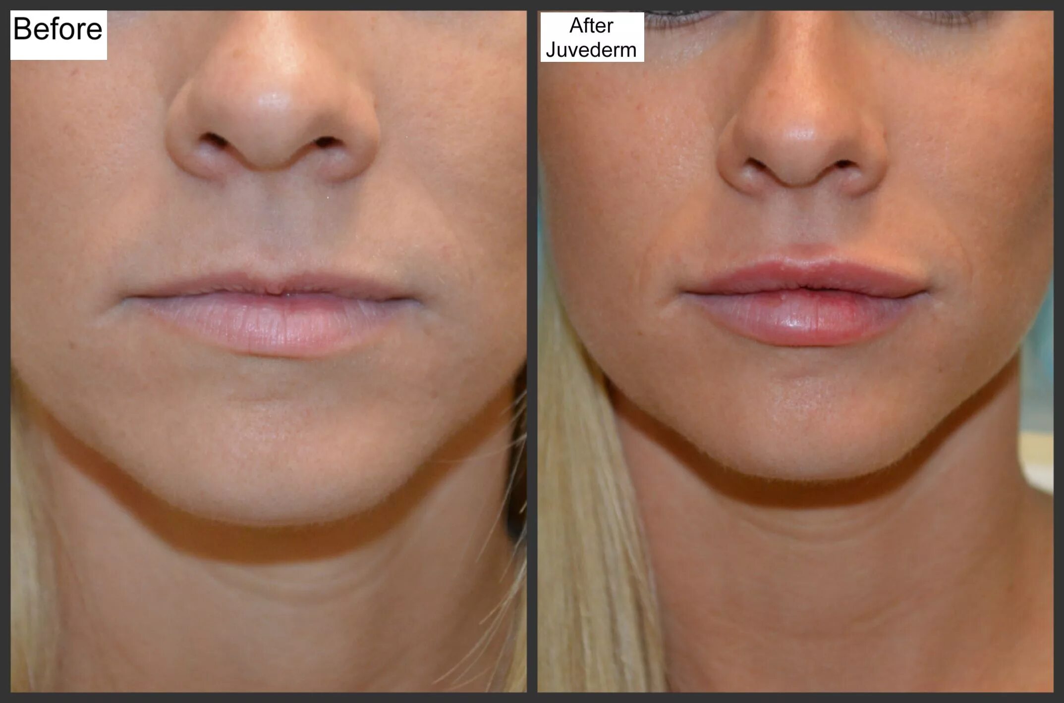 Плоские губы фото до и после Pin on Juvederm (New Lips)