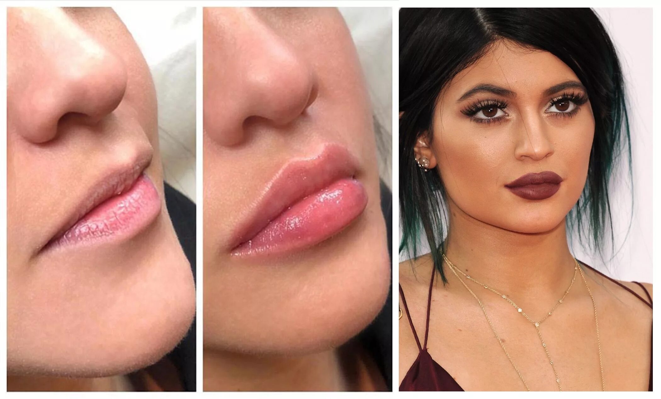 Плоские губы фото до и после Meet Lip Threads, the New Lip Fillers That Promise You a Better Pout! Lip filler