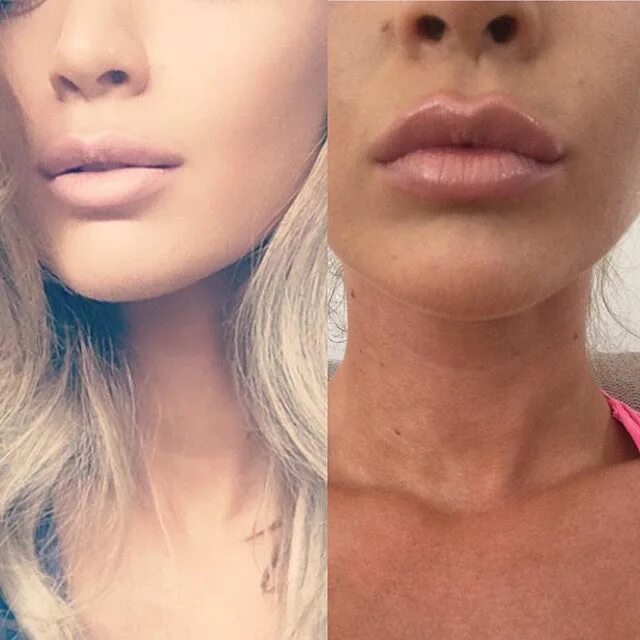 Плоские губы фото до и после Are you looking to get those lips enhanced????.Call us on 01273660506 to book a 
