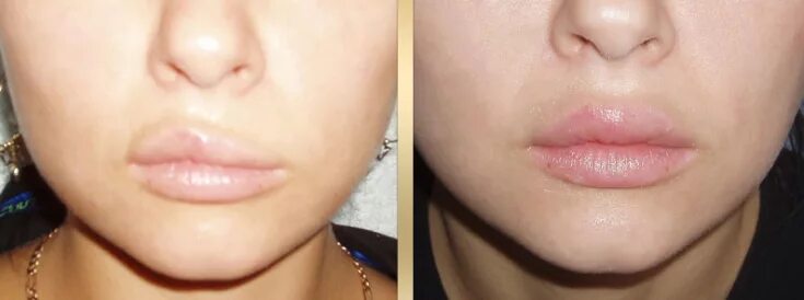 Плоские губы фото до и после Biopolymer in the lips - the risks of the procedure - Estet-Portal