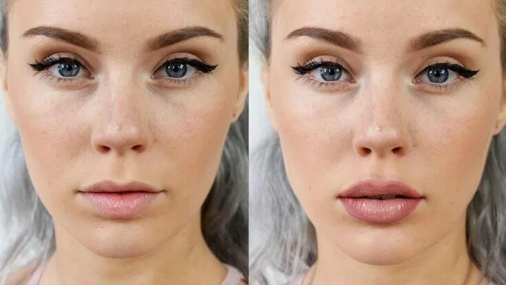 Плоские губы фото до и после #celebritiescutelips Botox lips, Lip plumper, Lip fillers