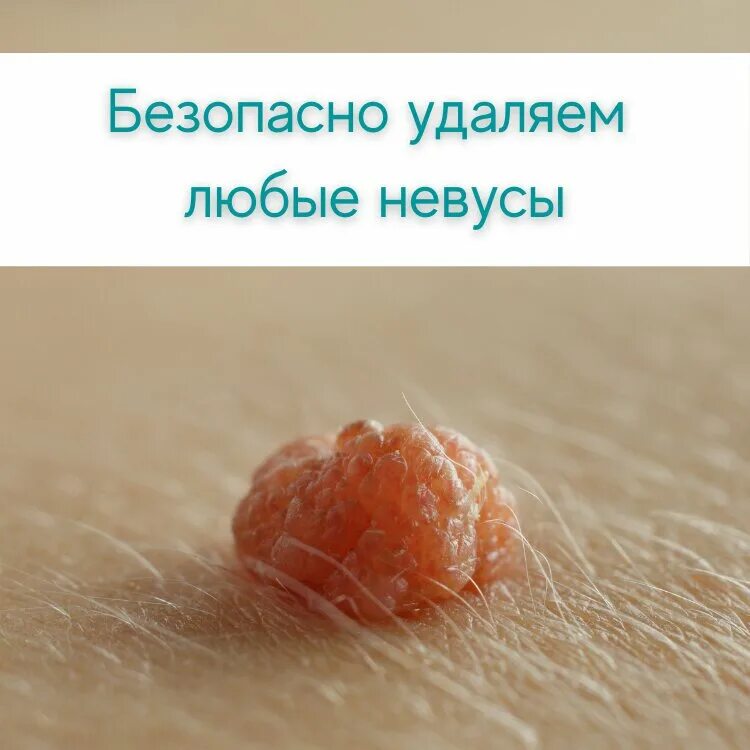 Плоские папилломы на теле фото лечение народными Permanently closed: MB Cosmetics, beauty salon, Saint Petersburg, Orlovskiy Lane