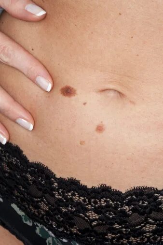 Плоские папилломы на теле фото лечение народными Skin Cancer Stockfoto und mehr Bilder von Bauchnabel - iStock