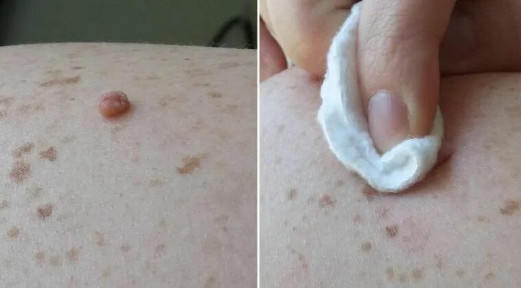 Плоские папилломы на теле фото лечение народными Pin on DIY health, external