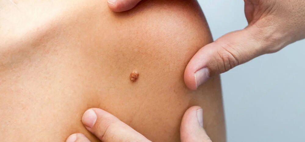 Плоские папилломы на теле фото лечение народными Вакцинация при планировании беременности - симптомы, диагностика, лечение в НКЦ 