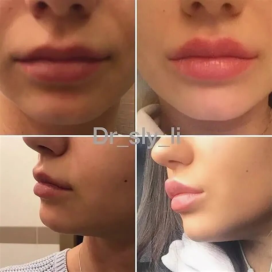 Плоский бант фото до и после 16 ideas de Labios maquillaje labios, maquillaje, maquillaje de labios