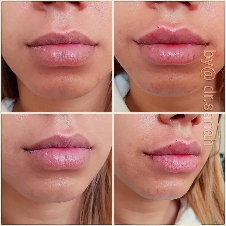 Плоский бант техника увеличения фото his Client Had: - enhanced the shape - sharpened the cupid's bow - corrected the