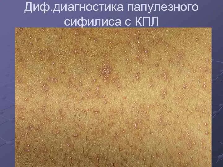 Плоский лишай фото симптомы Пробковая болезнь eCookie.ru