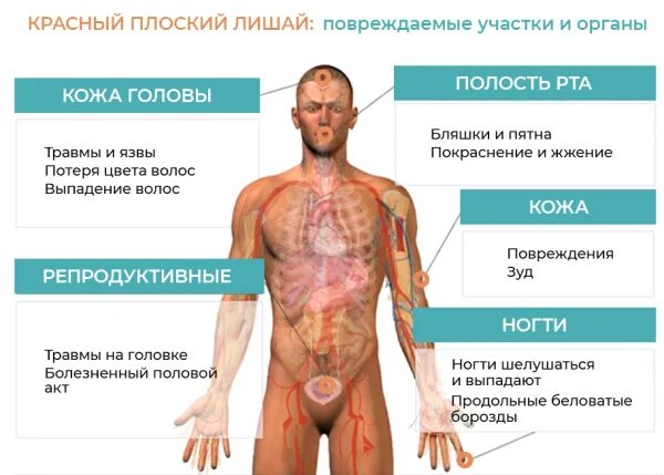 Плоский лишай фото у человека лечение Farmf литература для фармацевтов : Лекции " Красный плоский лишай. Классификация