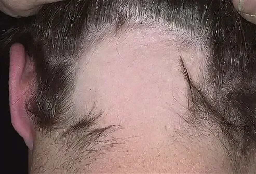 Плоский лишай на голове фото Alopecia Areata Causes, Regrowth Signs, Symptoms & Treatment
