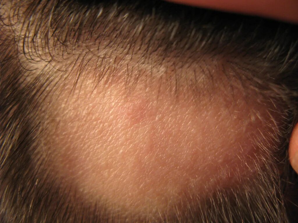 Плоский лишай на голове фото alopecia grow back The bald spot on the back of my head se. Flickr