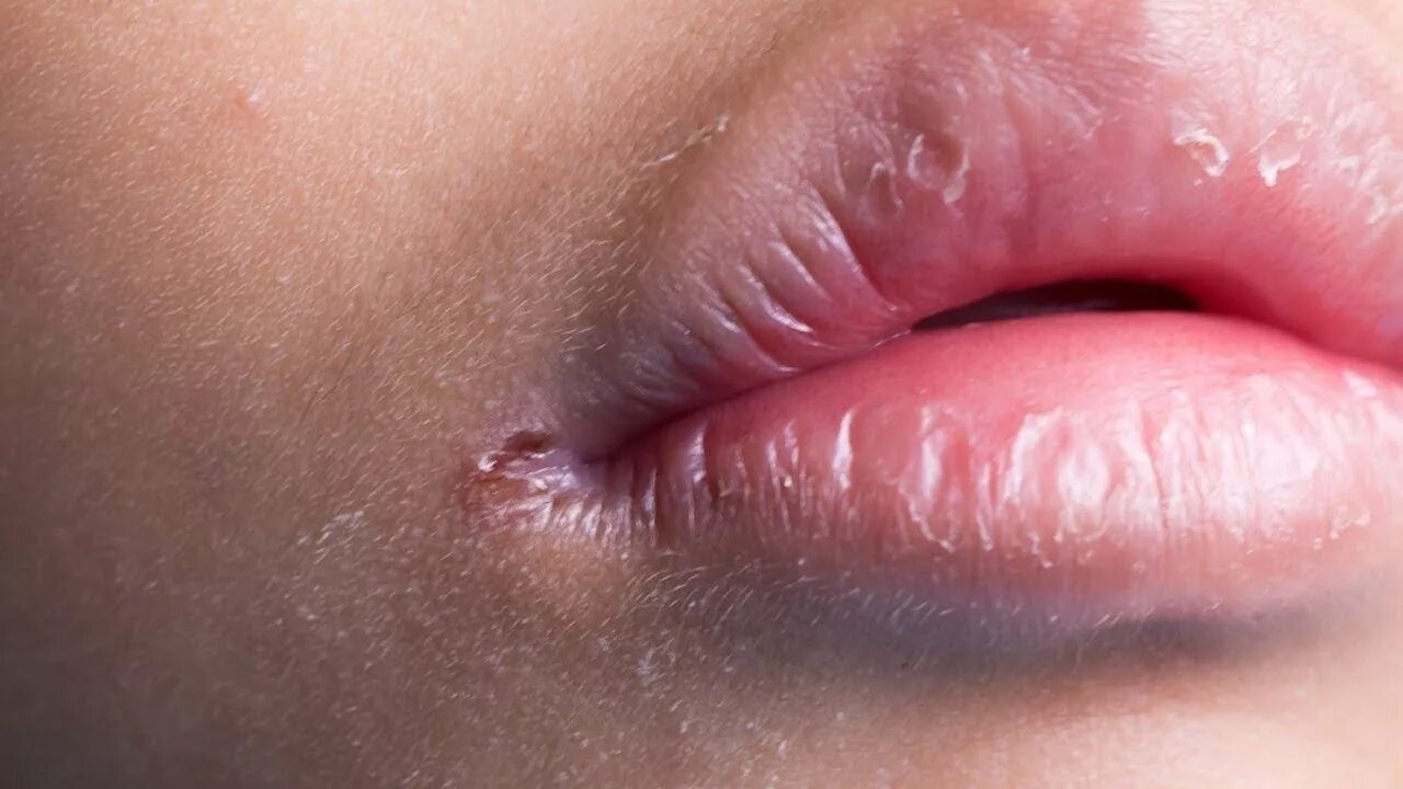 Плоский лишай на губах фото HOW TO HEAL CRACKED LIP EDGES - NATURAL MANAGEMENT FOR ANGULAR CHEILITIS - YouTu
