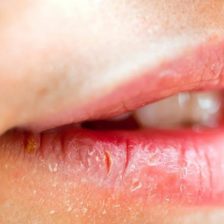 Плоский лишай на губах фото 10 ideas económicas para una boda en la playa Tips de maquillaje, Labios secos, 
