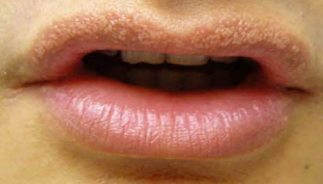 Плоский лишай на губах фото White Spots On Corner Of Lips - Release Date Price Reviews