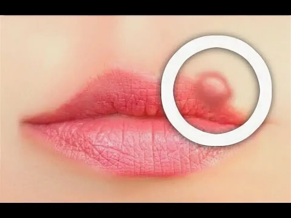 Плоский лишай на губах фото Hoe koortsblaasjes vermijden? - YouTube