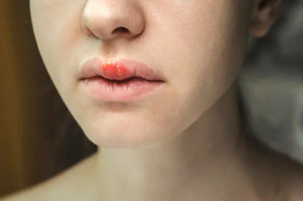 Плоский лишай на губах фото Более 80 работ на тему "Herpes Scabs": стоковые фото, картинки и изображения roy