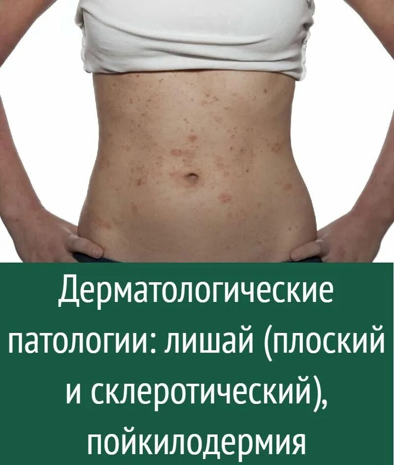 Плоский лишай на коже фото Здоровье
